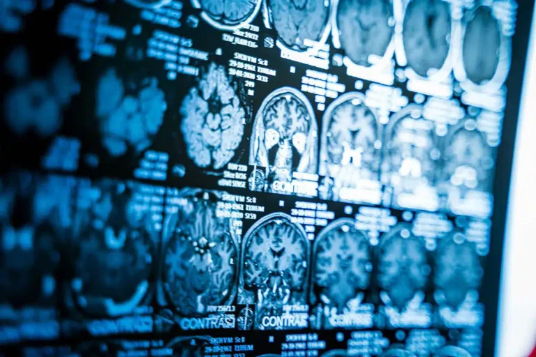 immagine che mostra risultati radiografie per sezione neurochirurgia